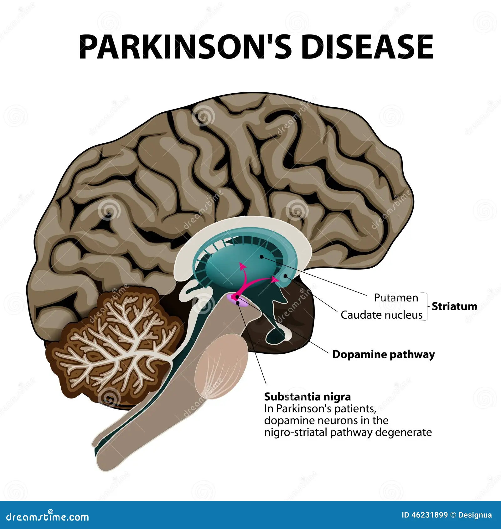 BỆNH PARKINSON: CHẨN ĐOÁN VÀ ĐIỀU TRỊ