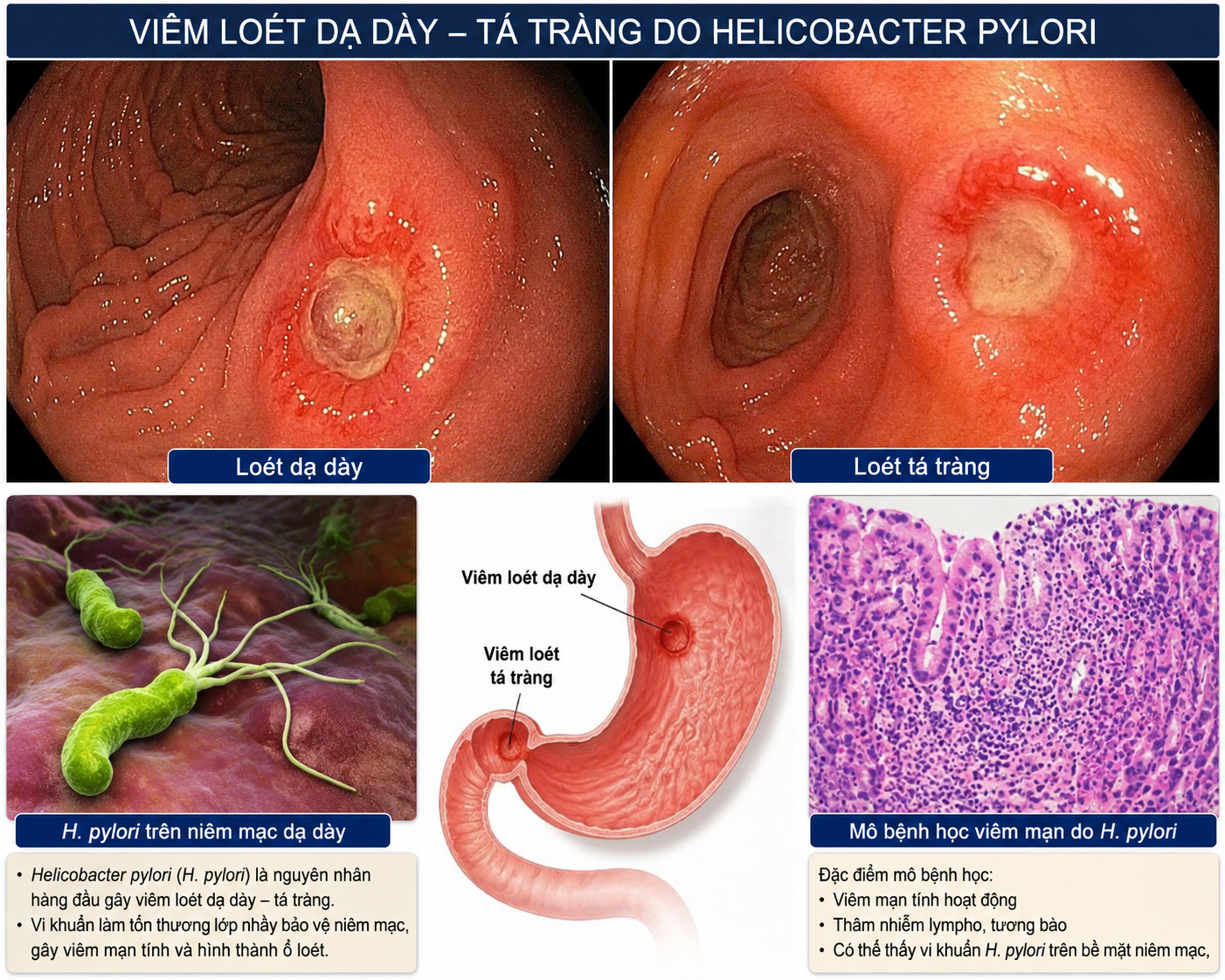 Vai trò của Vi khuẩn HelecoBactePylori